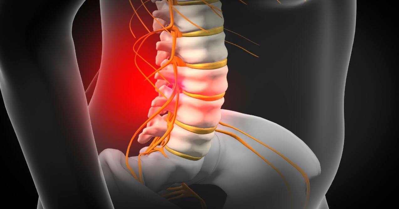 3D illustration of inflamed spinal facet joint with nerves