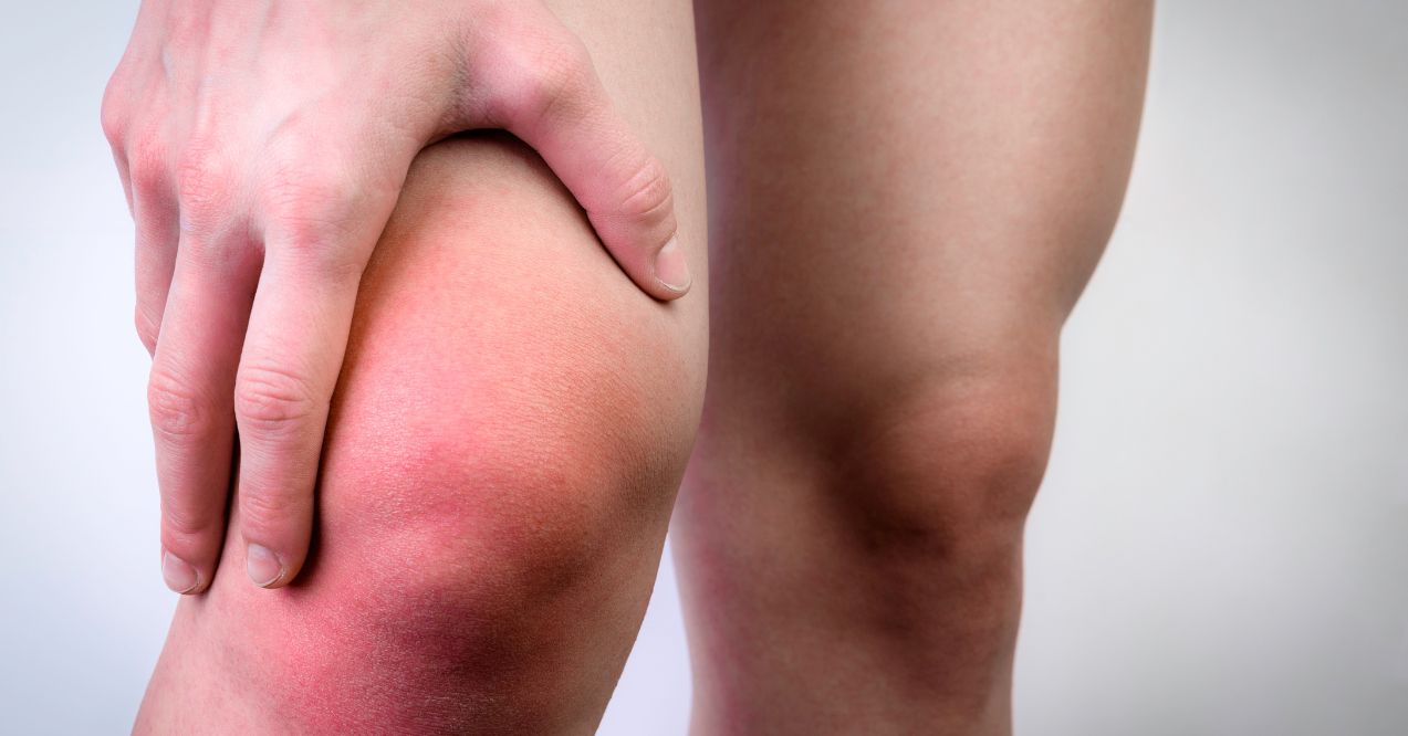 Swollen and inflamed knee area possibly indicating lymph nodes behind the knee.