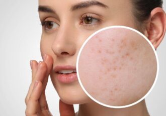 Close-up of woman’s face with zoomed-in view of lymphatic acne on her cheek